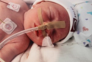 Gijs gastroschisis